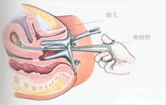 和田专家解析安全期意外怀孕怎么办